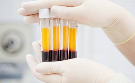 استفاده از پلاسمای خون بیماران بهبود یافته برای درمان کووید-۱۹؛ آزمایشات آغاز شد