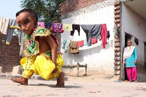 کودک عجیب الخلقه هندی