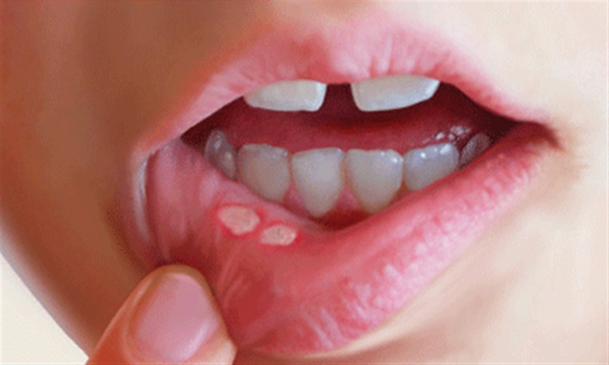 درمان آبریزش بینی و آفت دهان با نمک!