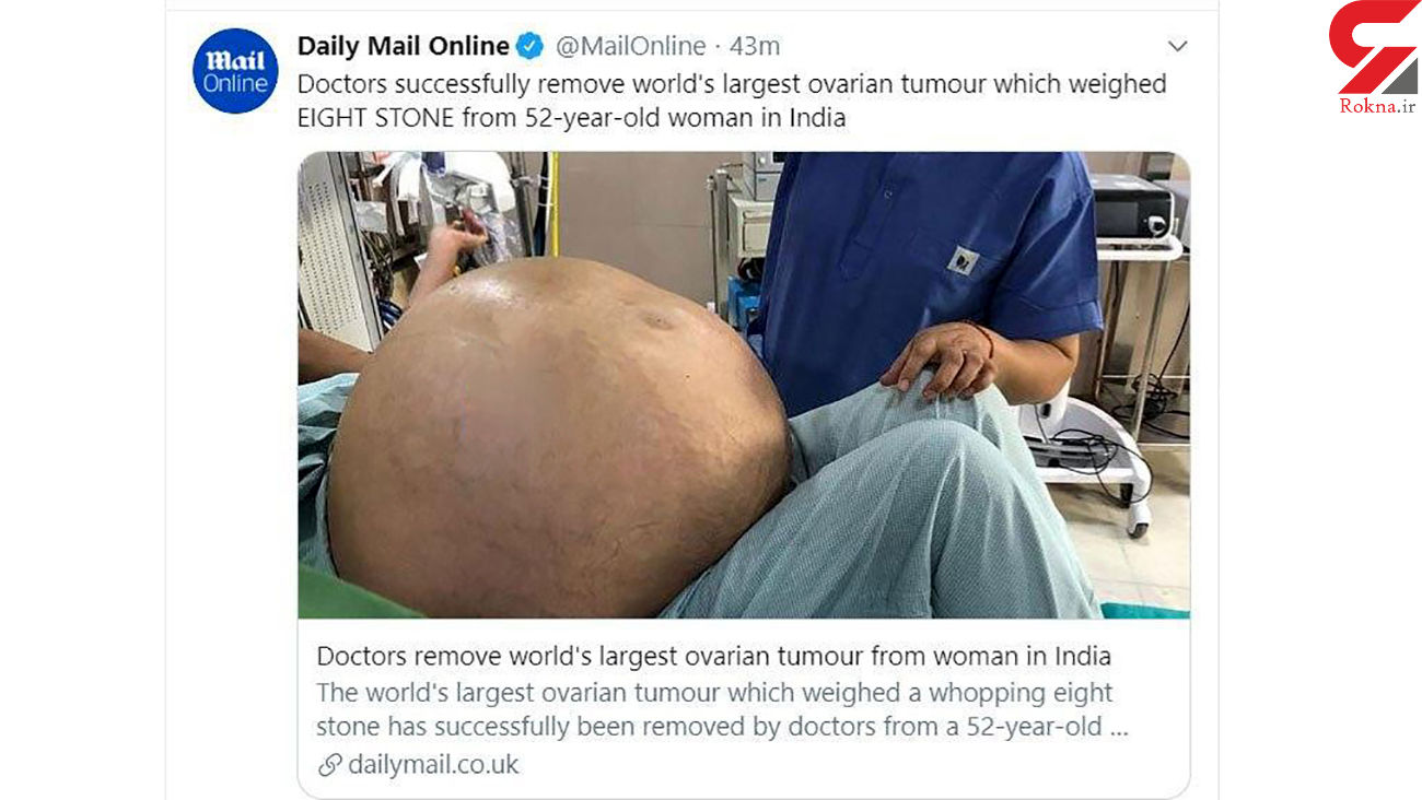 خارج کردن تومور بزرگ تخمدان از شکم یک زن در هند