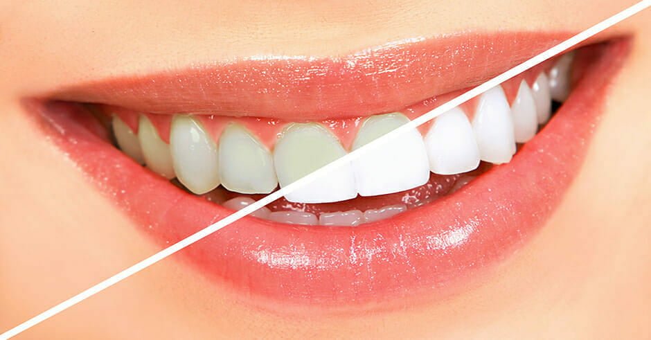 روش هایی برای سالم نگه داشتن دندان ها