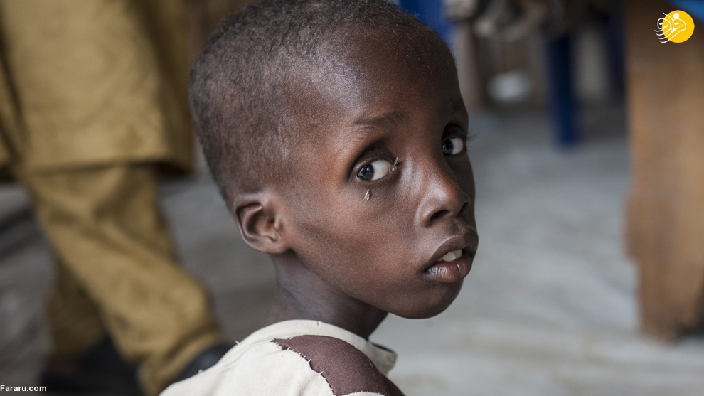 مالاریا بین کودکان نیجیریه