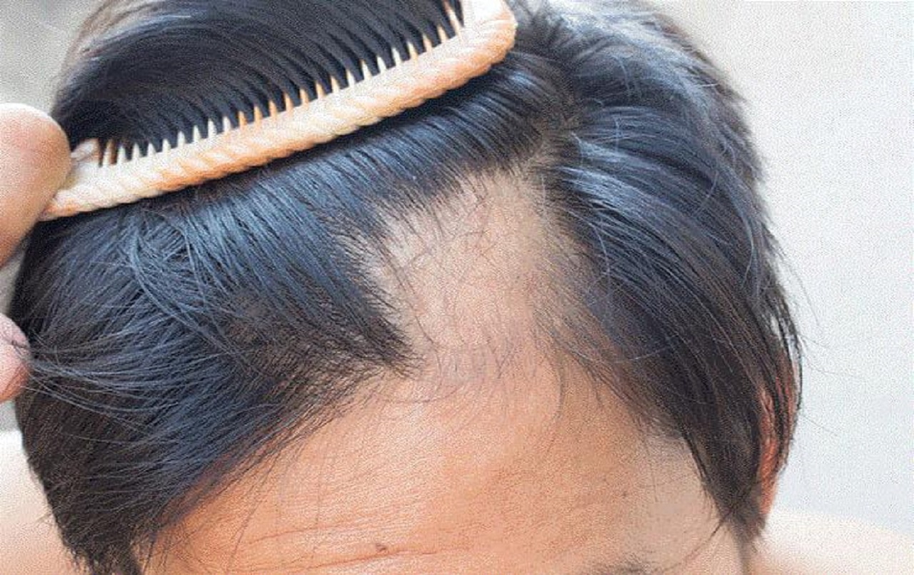 داروهای موثر در ریزش مو