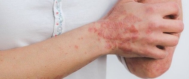 کرونا چه مشکلاتی برای پوست 