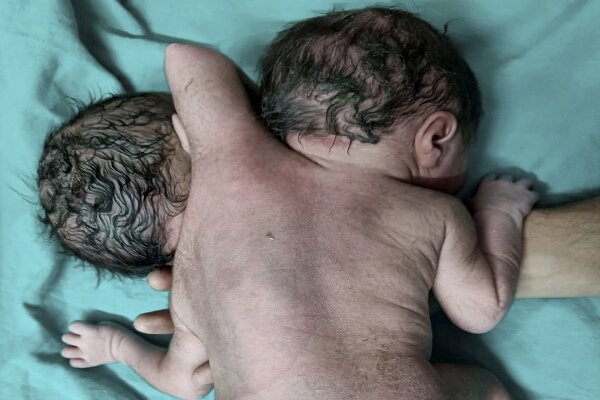 تصاویری از عجیب‌ترین نوزاد جهان در هند