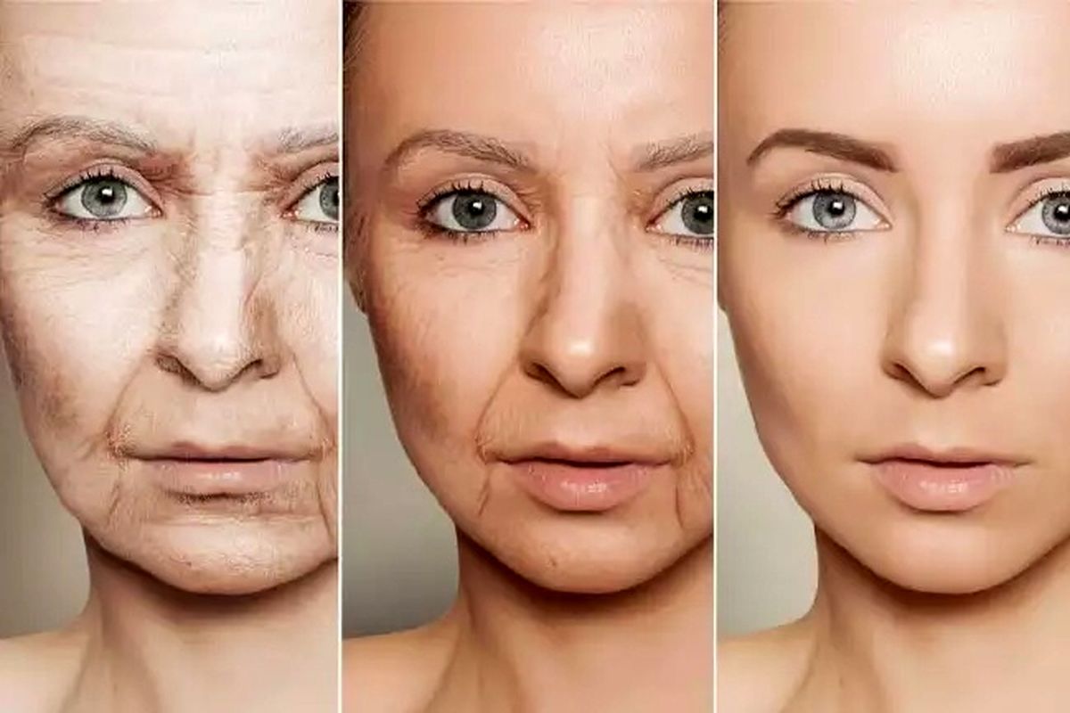 چینوچروکهای پوستی چینوچروکهای پوستی