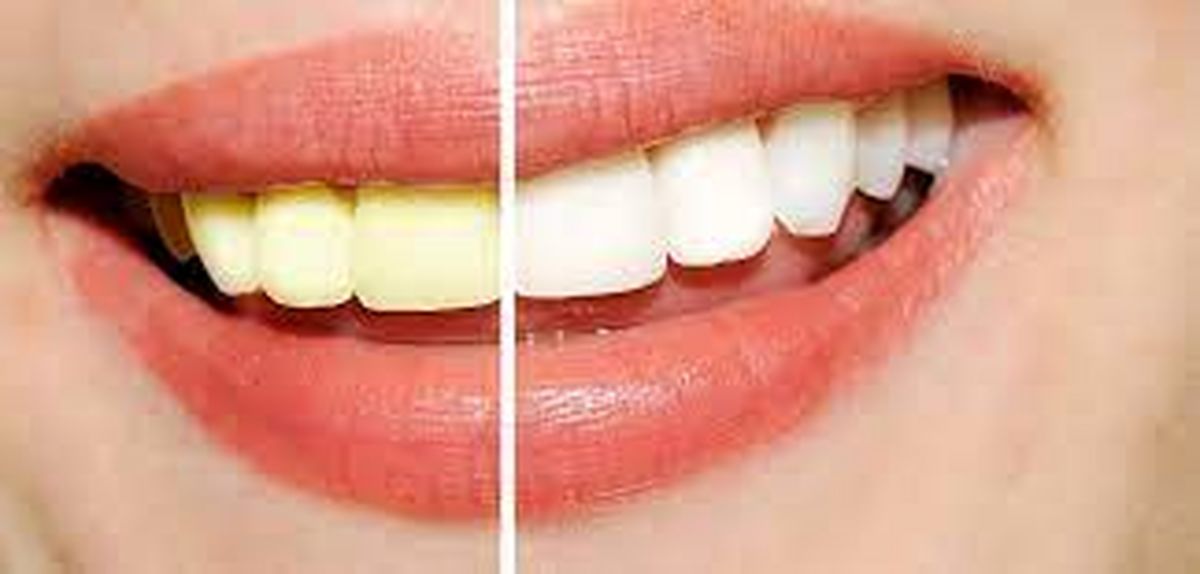 زرد شدن رنگ دندان‌ها