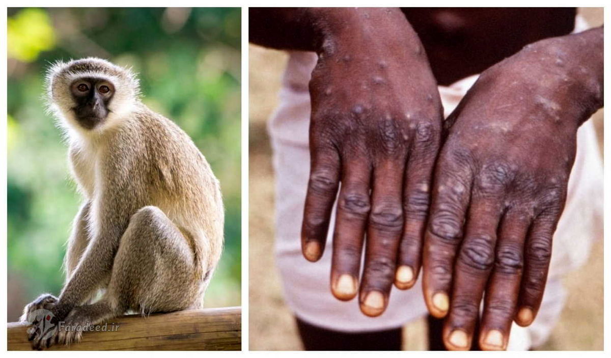 گزارش ترسناک سازمان جهانی بهداشت درباره سرعت شیوع آبله میمون
