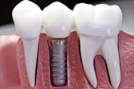 دندانپزشکی و تاثیر ایمپلنت