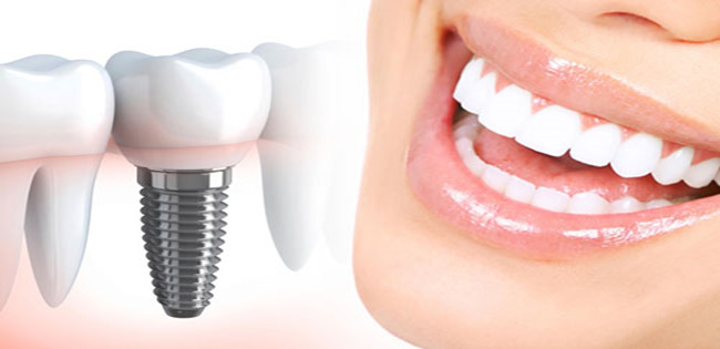 بررسی ایمپلنت دندان ایرانی
