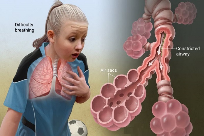 علت بروز بیماری آسم