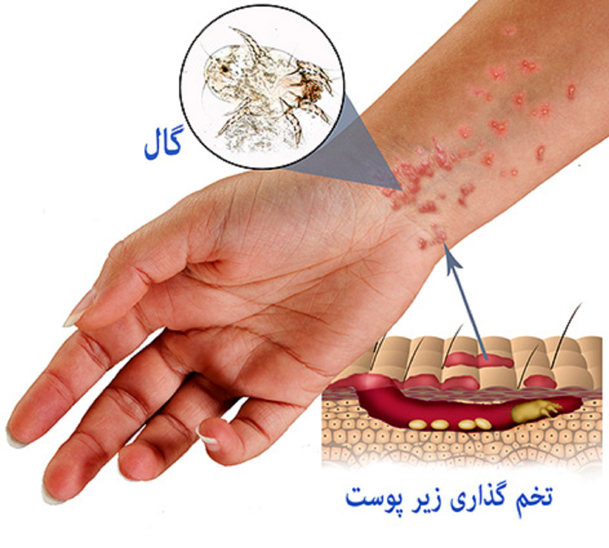 علائم بیماری گال