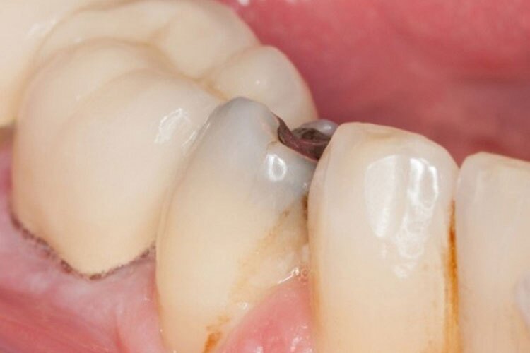 پوسیدگی دندان‌ها