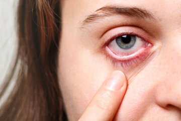 درمان بیماری‌ چشمی ناشی از آلودگی هوا