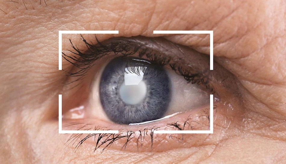 اسکن چشم و پارکینسون