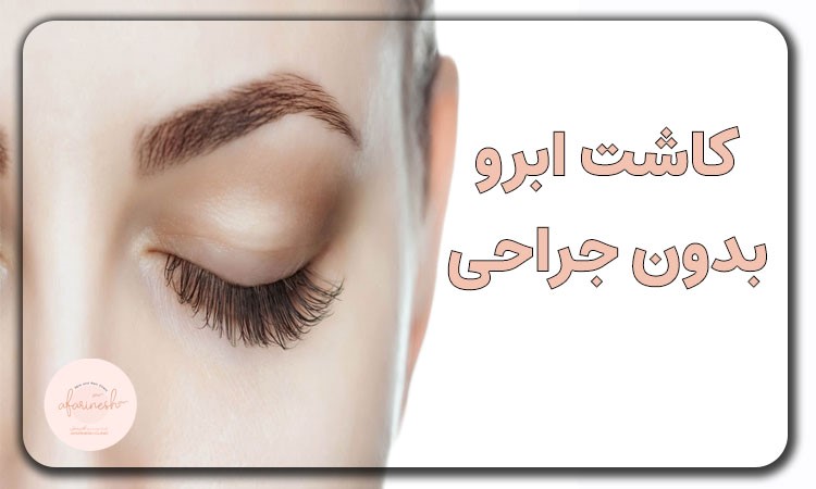 کاشت ابرو بدون برش سر