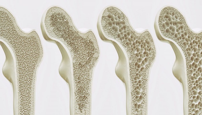 ۴ عامل خطر بروز پوکی استخوان