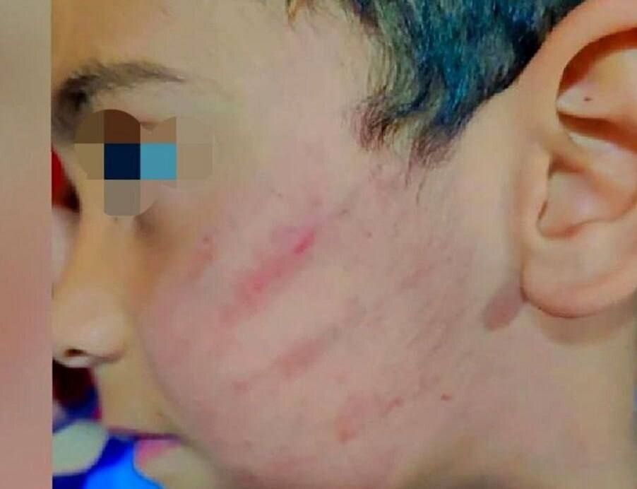 تصویر صورت کتک‌خورده یک دانش آموز کلاس اول خبرساز شد