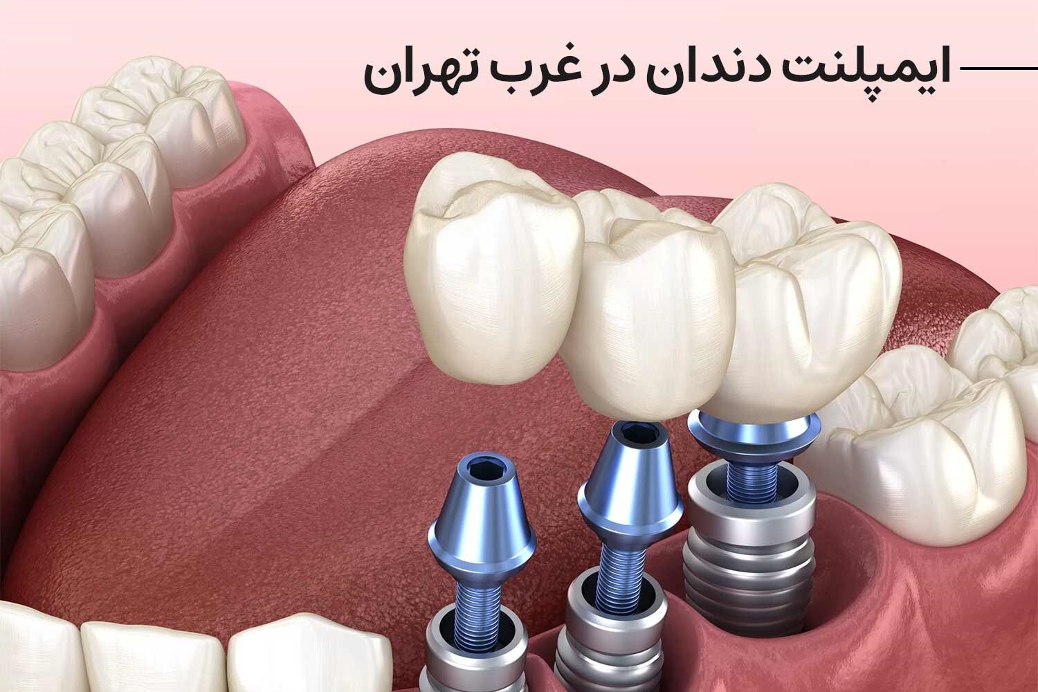 ایمپلنت دندان در صاقیه تهران (ایمپلنت دندان در غرب تهران)