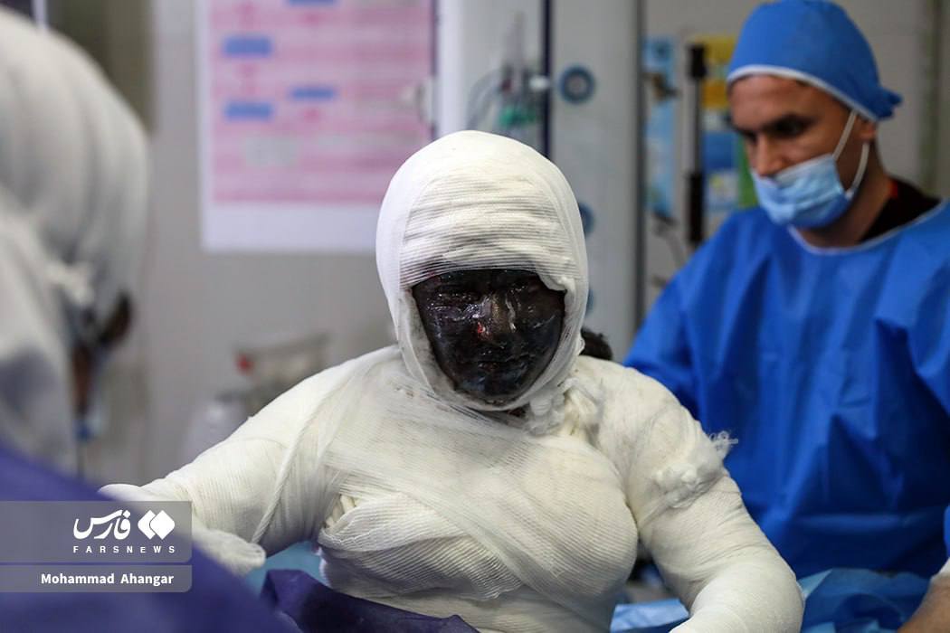 عکس/ تصویری هولناک از یکی از مصدومان چهارشنبه‌سوری امسال