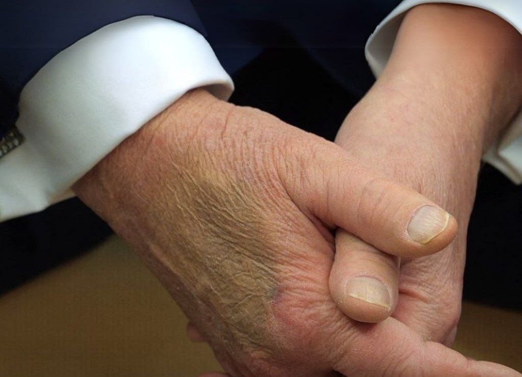 کبودی روی دست ترامپ خبر ساز شد