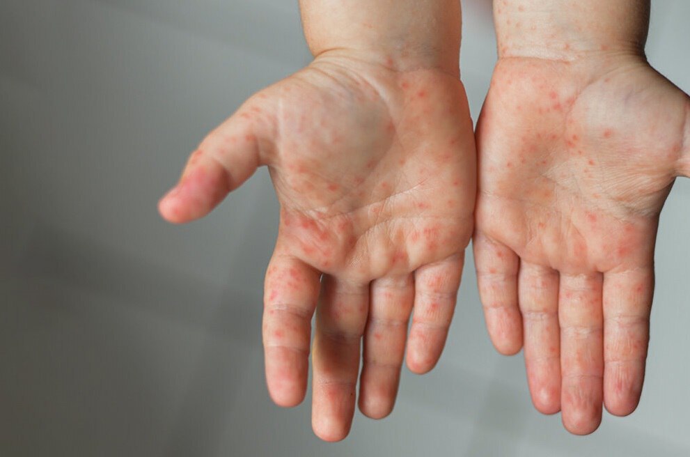 شیوع سرخک در ایران