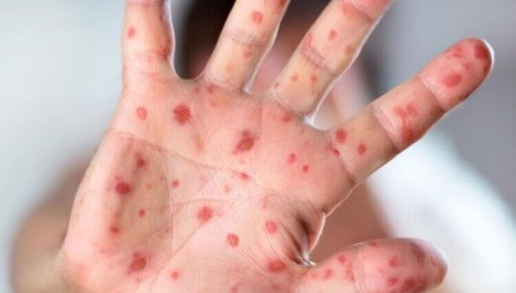 بیماری سرخک بیماری سرخک