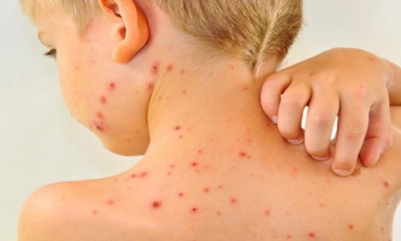 بیماری سرخک از کدام کشور وارد ایران شد؟