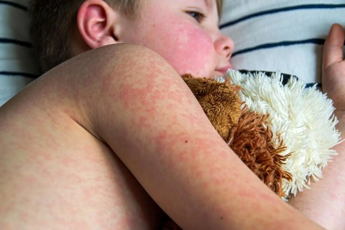 بیماری سرخک