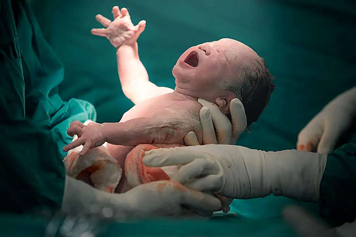 چرا آمار سزارین در ایران بالا است؟