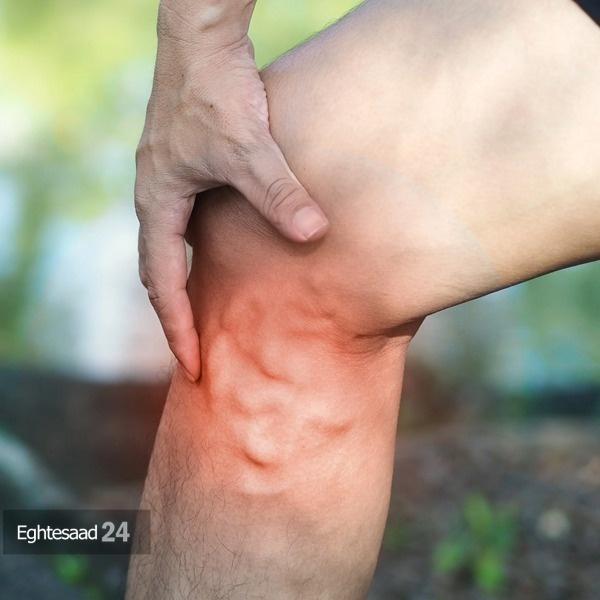 چا افرادی نسبت به علائم اولیه واریس حساسترند