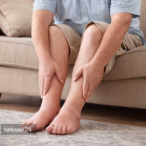 تورم جزئی پا‌ها در پایان روز