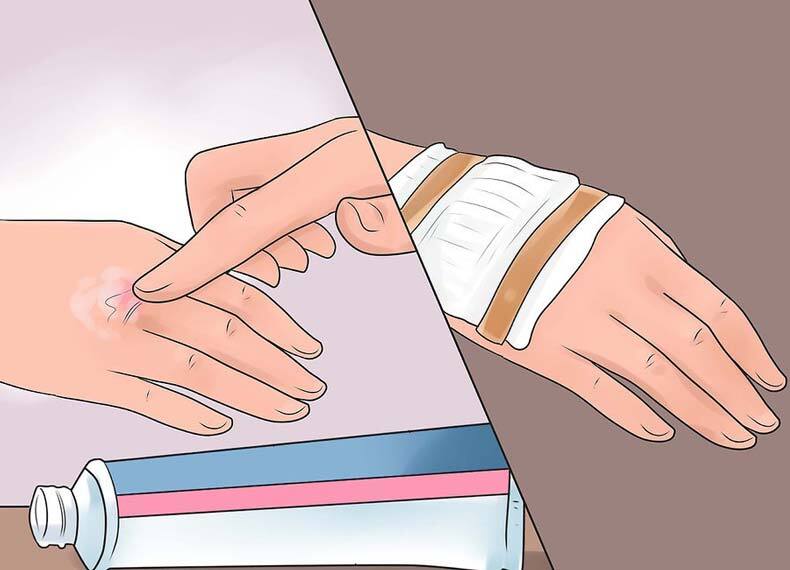 کمکهای اولیه در هنگام سوختکی