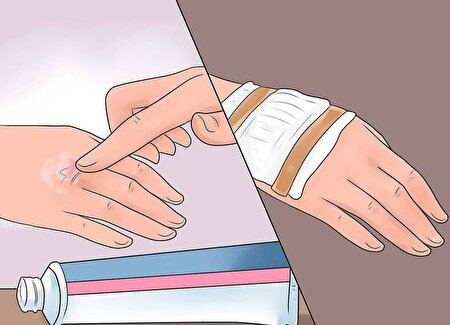 5 اقدام طلایی در مواجهه با سوختگی