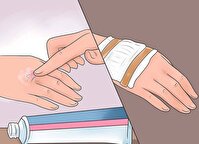 5 اقدام طلایی در مواجهه با سوختگی