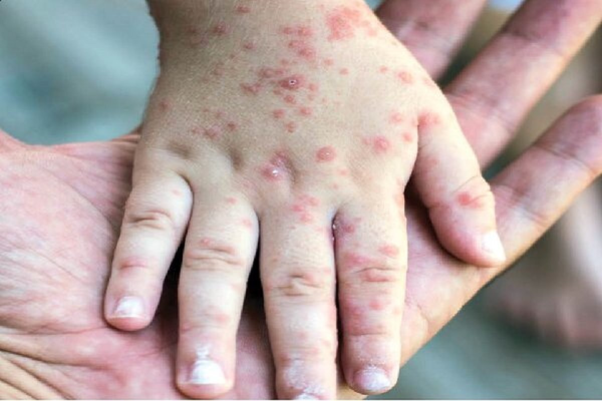 مراقب این بیماری در فصل بهار باشید