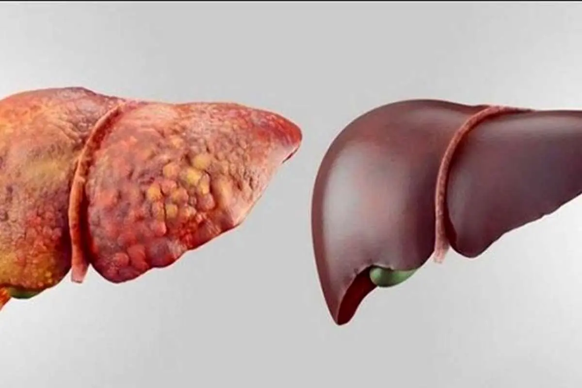 علائم کبد چرب