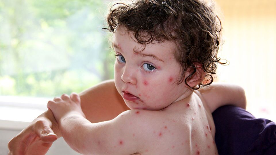 هشدار درباره شیوع فصلی آبله‌مرغان در فصل بهار