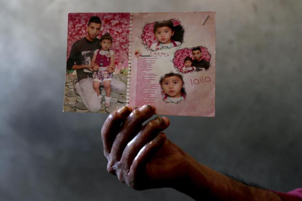 تهیه ماسک برای قربانیان سوختگی در غزه