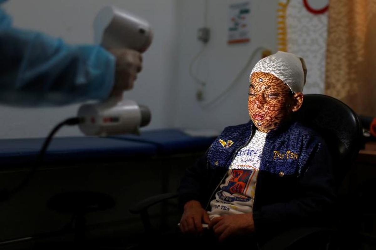 تهیه ماسک برای قربانیان سوختگی در غزه