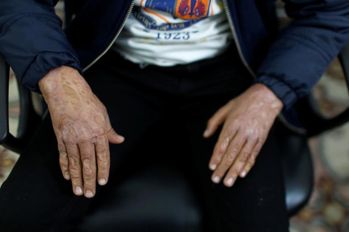 تهیه ماسک برای قربانیان سوختگی در غزه