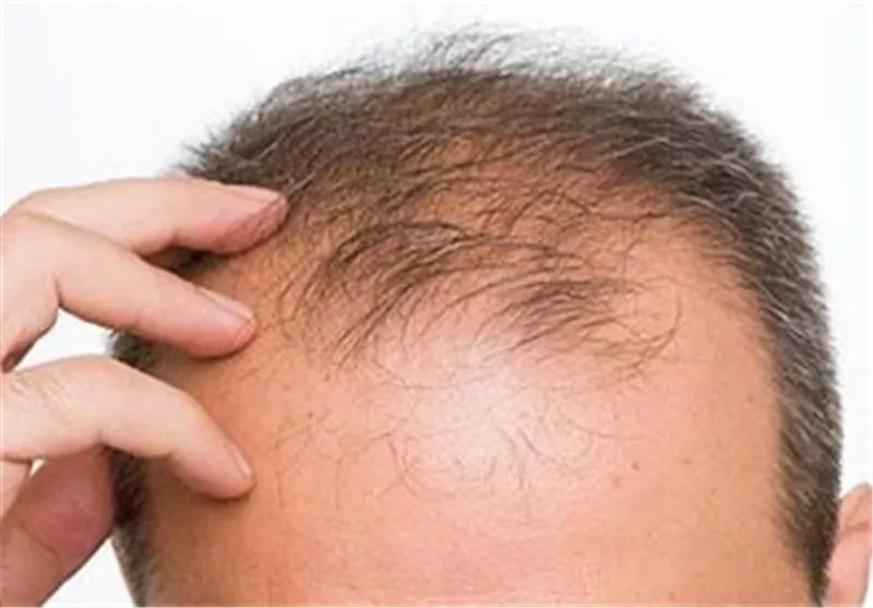 راهکار‌های طب سنتی برای جلوگیری از ریزش مو