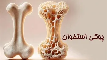 فیلم/یک روش آسان برای پیشگیری از پوکی استخوان