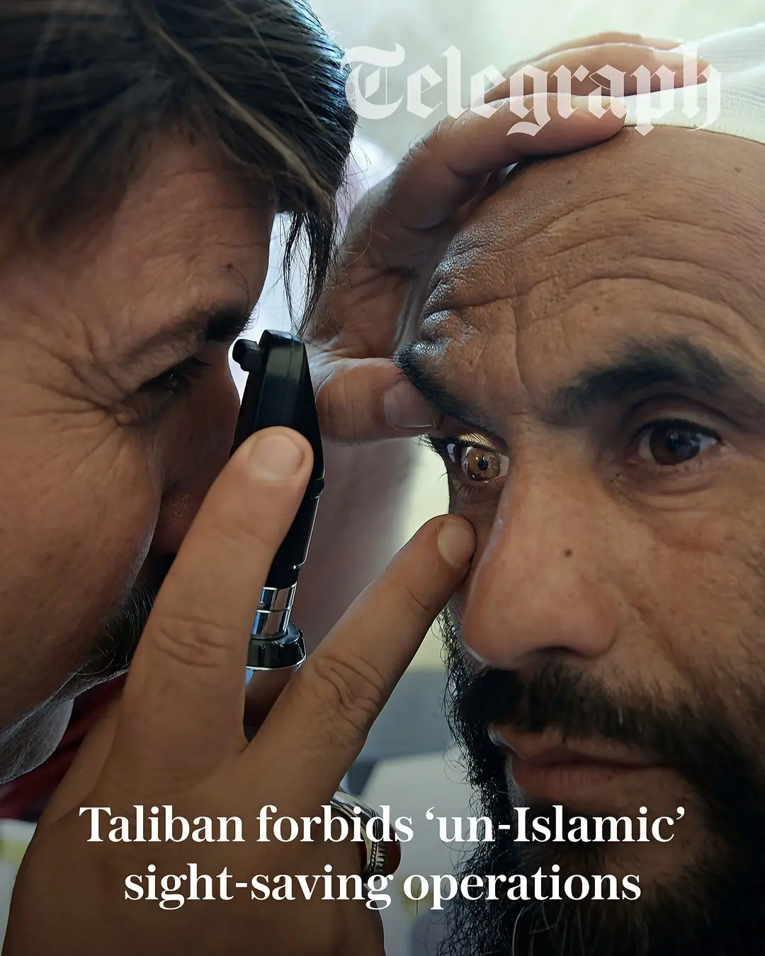 پیوند قرنیه چشم