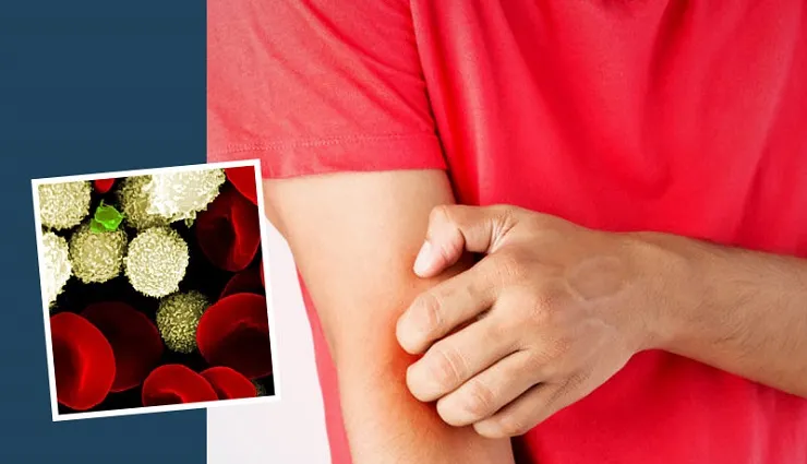 همه چیز درباره  بیماری سپسیس
