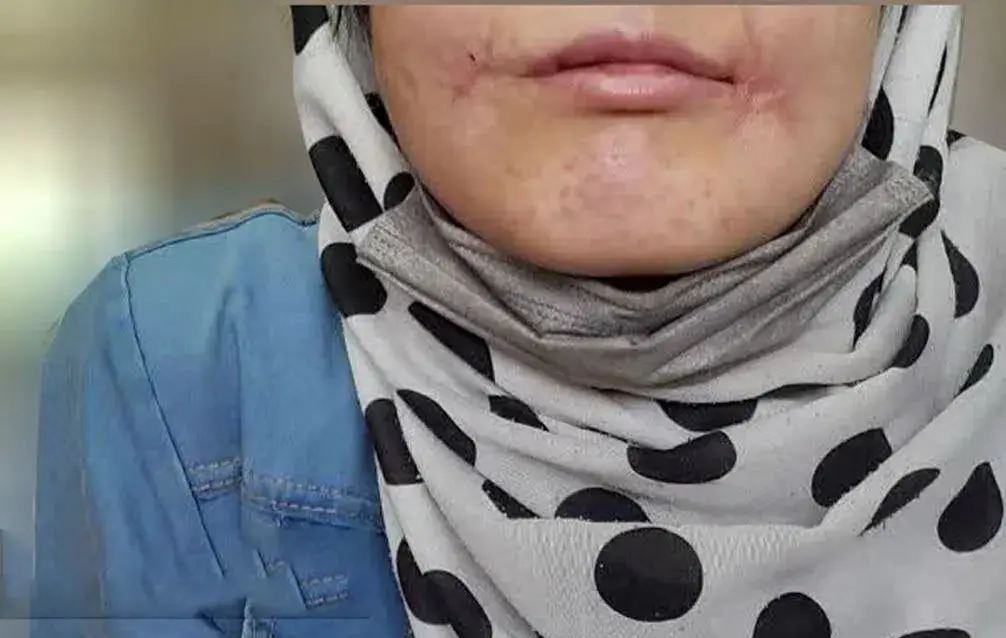 مرد مشهدی لب‌های همسرش را دوخت!