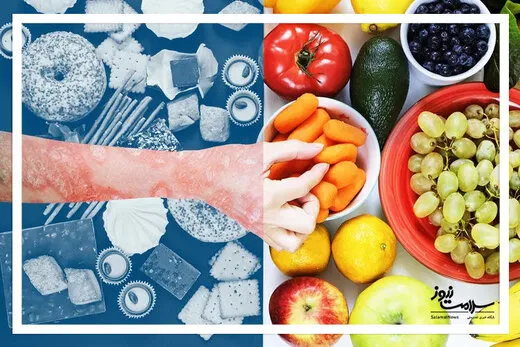 رابطه میان پسوریازیس و رژیم غذایی