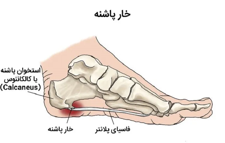خار پاشنه پا چیست چه علائمی دارد و چگونه درمان می‌شود؟
