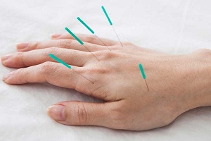 طب سوزنی