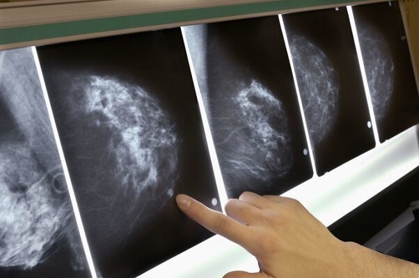 پیش بینی دقیق سرطان سینه